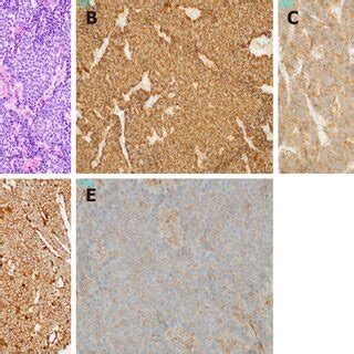 Microscopic Findings Of The Tumor A Atypical Cells With Small Round