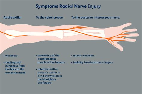 Radial Nerve Peripheral Upper Extremity Ep Wellness And Functional Medicine Clinic