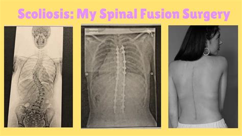 Scoliosis My Spinal Fusion Surgery Youtube