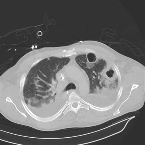 Figure Bilateral Pneumonia Computed Tomography Scan StatPearls