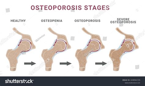 Stages Osteoporosis Bone Spongy Structure Normal Stock Vector Royalty