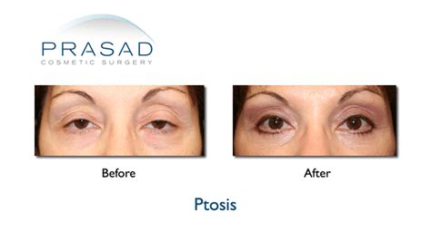 Ptosis Surgery Droopy Eyelid New York Specialist