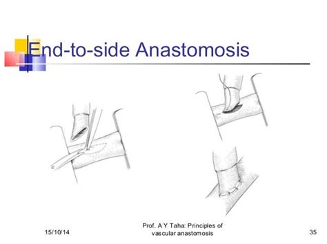 Principles Of Vascular Anastomosis