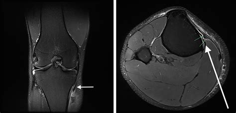 Distal Avulsion Of The Semitendinosus Tendon A Case Report Thomas