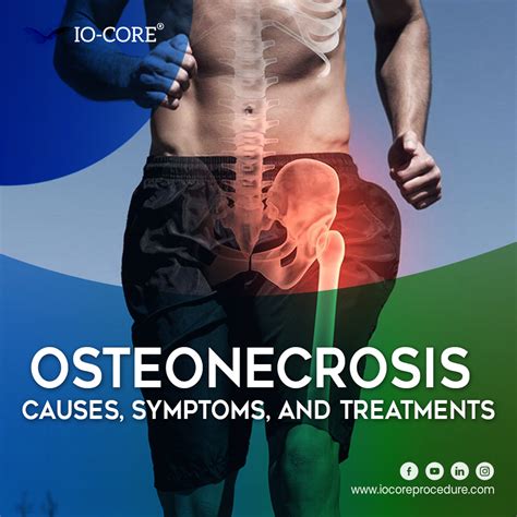 Osteonecrosis: Causes, Symptoms, and Treatments | iO-Core