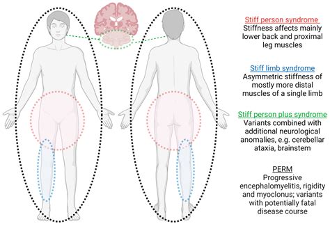 Biomedicines Free Full Text Stiff Person Spectrum Disordersan