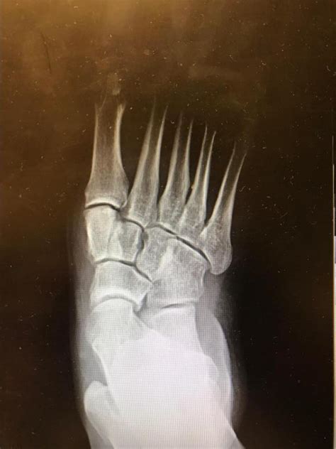 Figure Adult Acquired Flatfoot Radiograph Demonstrating