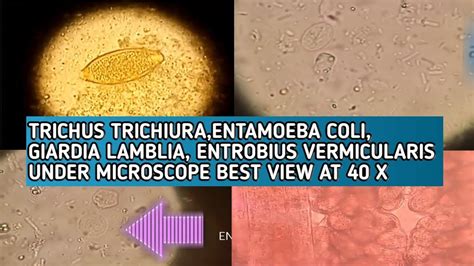 Trichus Trichuriaentamoeba Coligiardia Lamblientrobius Vermicularis Best Microscopic View At