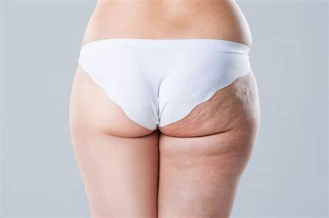 Combattre La Cellulite Les Bonnes Et Les Mauvaises Habitudes