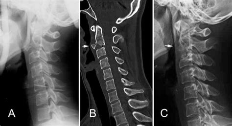 Flexion Vs Extension Teardrop Fracture