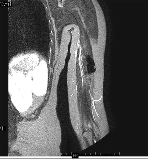 retained broken injection needle mri sumers radiology blog