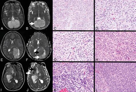 Figure 1 From Meningioma Histologic Subtypes Chordoid Meningiomas From Other Preoperative Mr