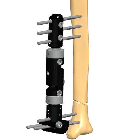 Tibia Bone Fracture Treatment Orthofix Abs