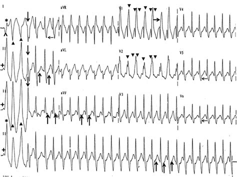 Diagrams Of Ecg Rhythms