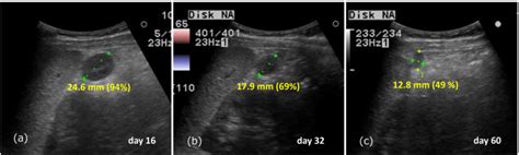 Ultrasound Follow Up A The Accessory Spleen Shrunk To 246 Mm 94