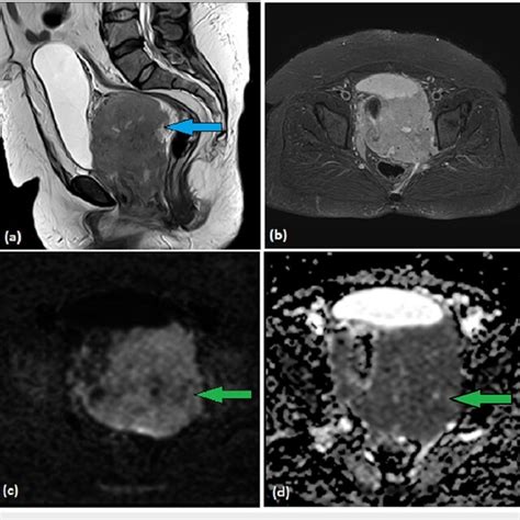 MRI T2W Sagittal A Axial STIR B DWI C And ADC D Images