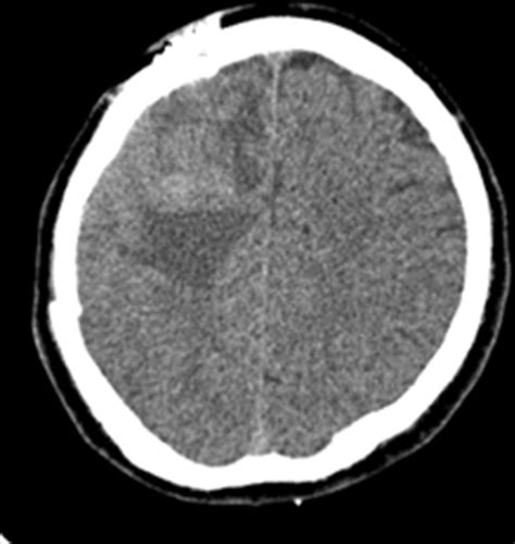 Brain CT scan showed recurrence of the previous tumor | Download ...