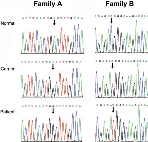 Dna Sequencing Chromatograms Showing The Mutations Of Affected Members