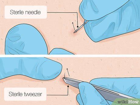 ingrown hair how to remove
