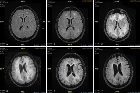 Doctors release scans of brain showing effects of cocaine use | Photo