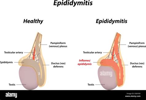 Epididimitis Fotografías E Imágenes De Alta Resolución Alamy