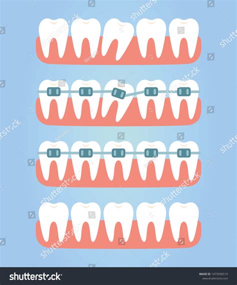 Stages Of Teeth Alignment Before And After Royalty Free Stock Vector