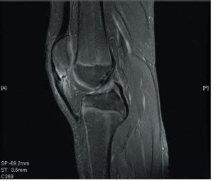 Sinding Larsen Johansson Syndrome Sports Medicine Review