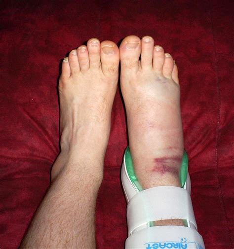 Albums 94 Pictures Pictures Of Sprained Ankle Excellent