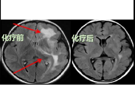 典型病例一例儿童弥漫性高级别胶质瘤，h3和idh野生型的治疗替莫唑胺胶质瘤弥漫性idh野生型h3化疗肿瘤脑干 健康界