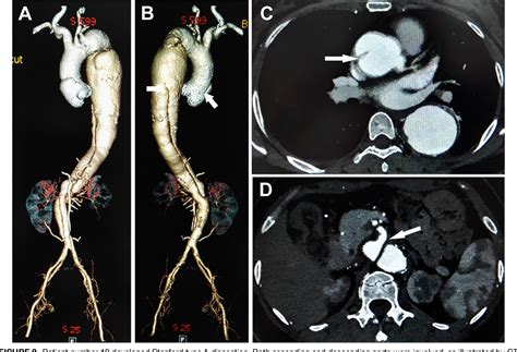 Figure 2 From Aortic Dissection In Takayasu Arteritis Semantic Scholar