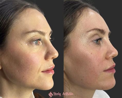 Smile Line Fillers Before After Results At Skinly