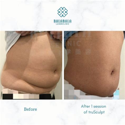 Trusculpt Body Sculpting Adelaide Balabala Laser Clinic