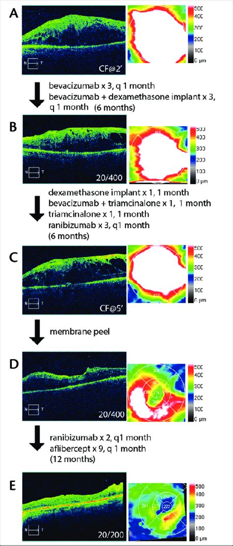 Surgical Management With Continued Anti Vegf And Dexamethasone Implant Download Scientific