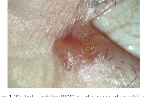 Figure 1 From Periocular Basal Cell Carcinoma—current Treatment Concepts Semantic Scholar