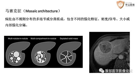 大咖讲座 饶圣祥教授解读肝脏影像报告及数据系统（li Rads V2018版）（课件及视频）中国