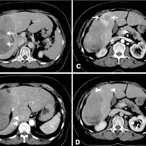 Abdominal Ct Reveals A 140 Mm Mass Enhanced Uniformly The Central Part Download Scientific