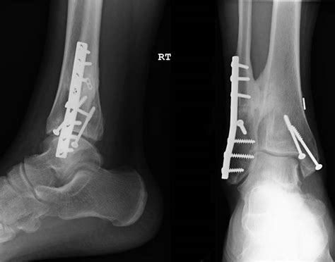 Tibiofibular Synostosis following Syndesmosis Fixation: A case report ...