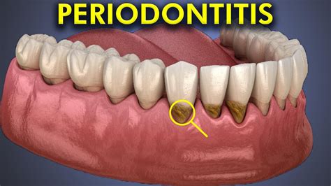 Periodontitis Or Periodontal Disease 3d Animation Youtube