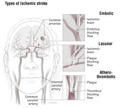 Lacunar Stroke Syndromes