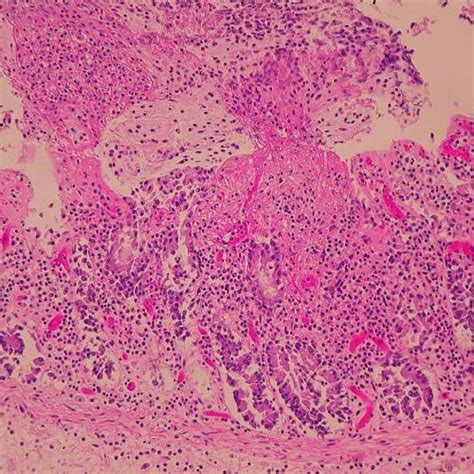 Microscopic Findings Of The Autopsy Specimen Showed The Summit Lesion