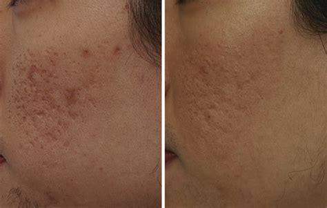 Beautiful results of treatment of acne scars using fractionated CO2 lasers