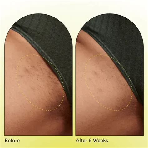 How To Remove Ingrown Bikini Hair Proven Solutions Hair Away By Laser