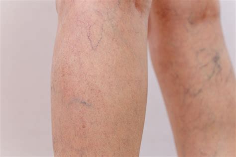 Spider Veins Treatment In Lexington Kentucky Lexington Vein Institute