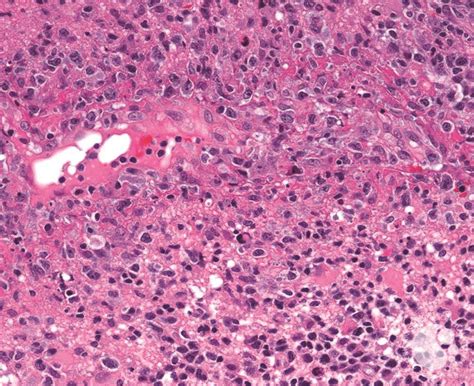 Monomorphic Post-transplant Lymphoproliferative Disorder H&E