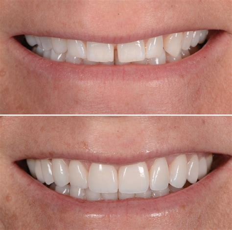 What Are Emax Veneers