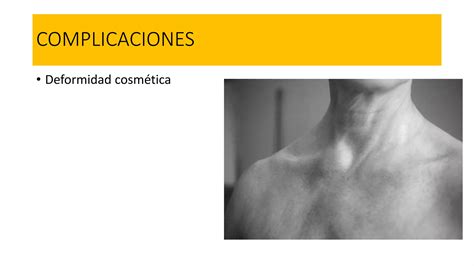 Luxacion Esternoclavicular Ppt