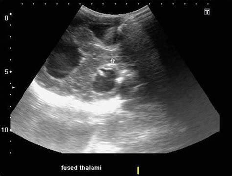 Holoprosencephaly causes, diagnosis, prognosis and treatment