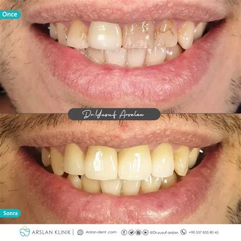 The Best Crowns And Bridges Service Arslan Dental Clinic