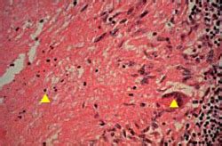 USMLE Pathology Slides - Lymph node: localized granuloma (caseous ...