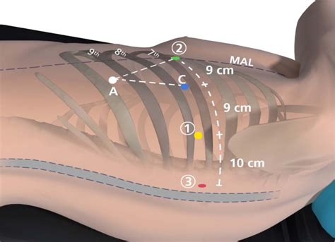 Robotic Lobectomy Left Upper Lobectomy Operative Techniques In